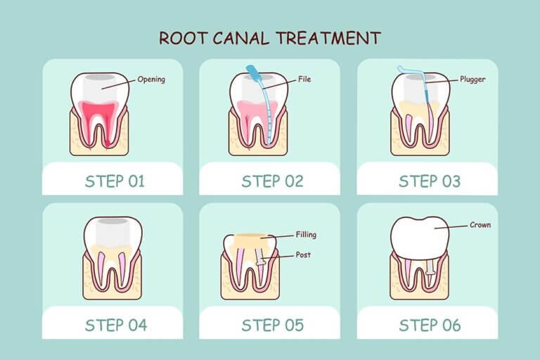 how-safe-is-root-canal