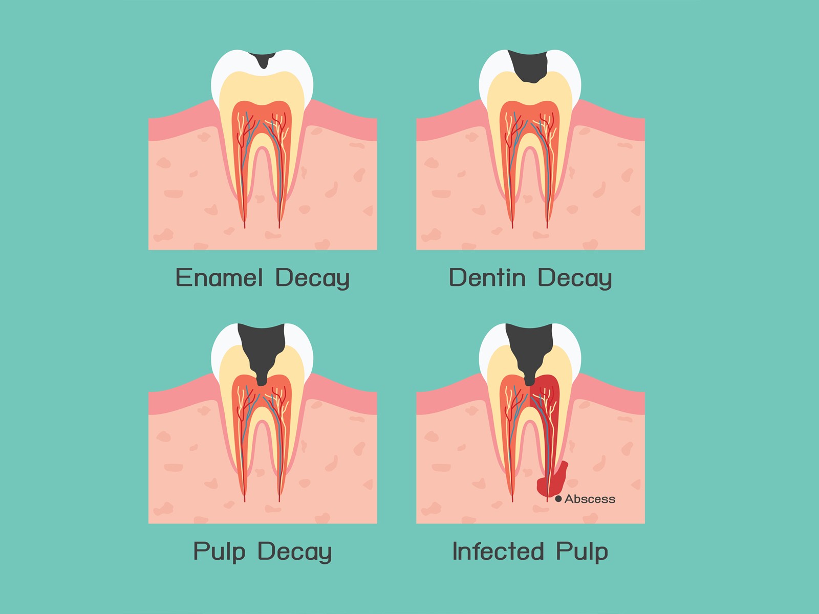 Images From Root Canal