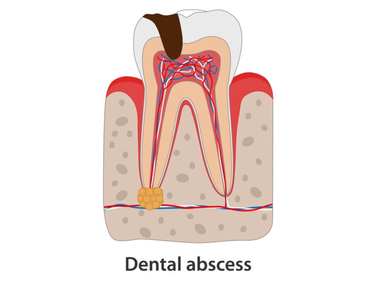 can-dental-abscess-go-away-on-its-own