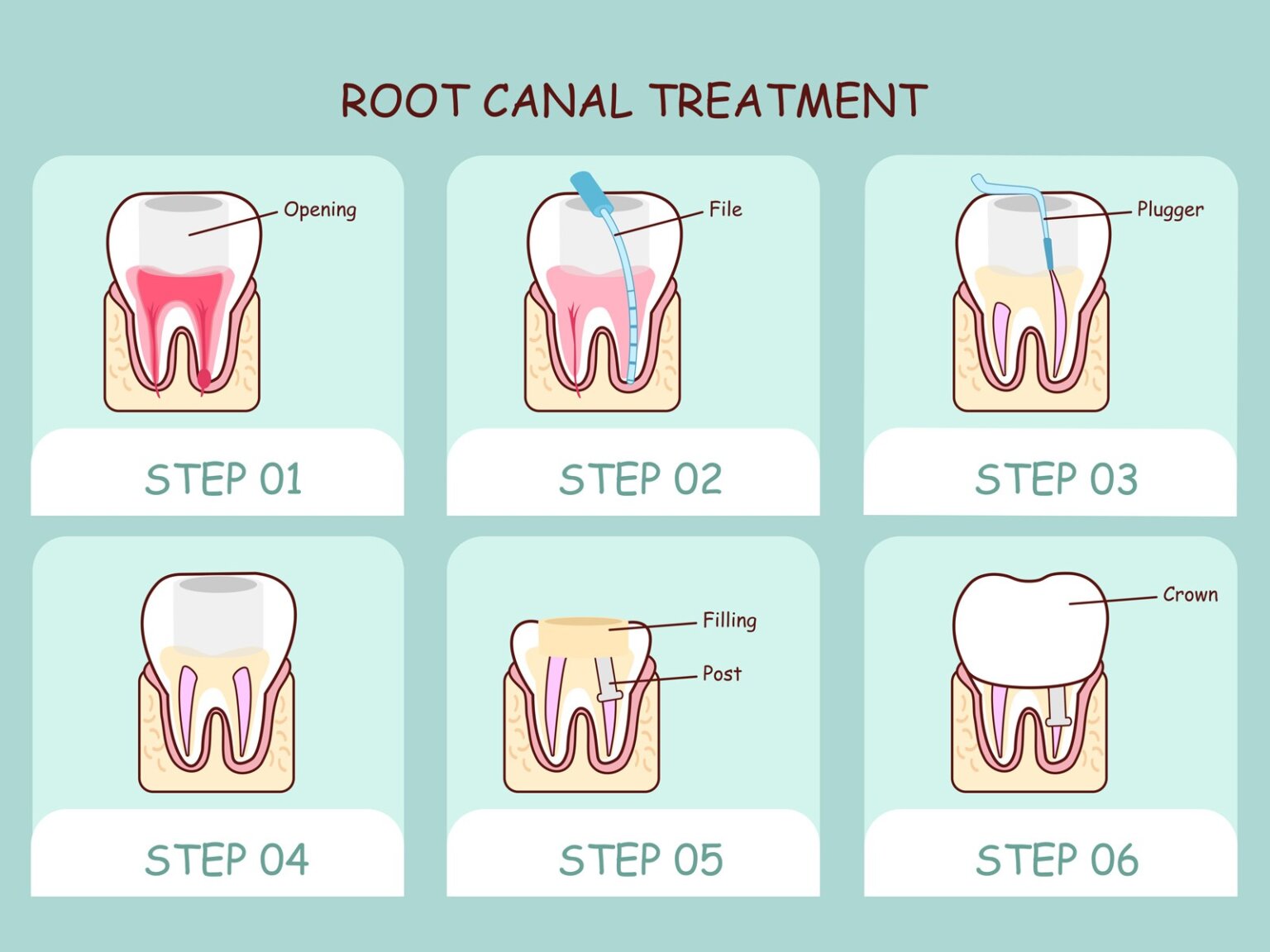 do-i-need-antibiotics-after-root-canal