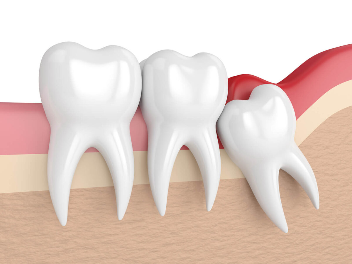 What To Expect During And After Wisdom Tooth Extraction