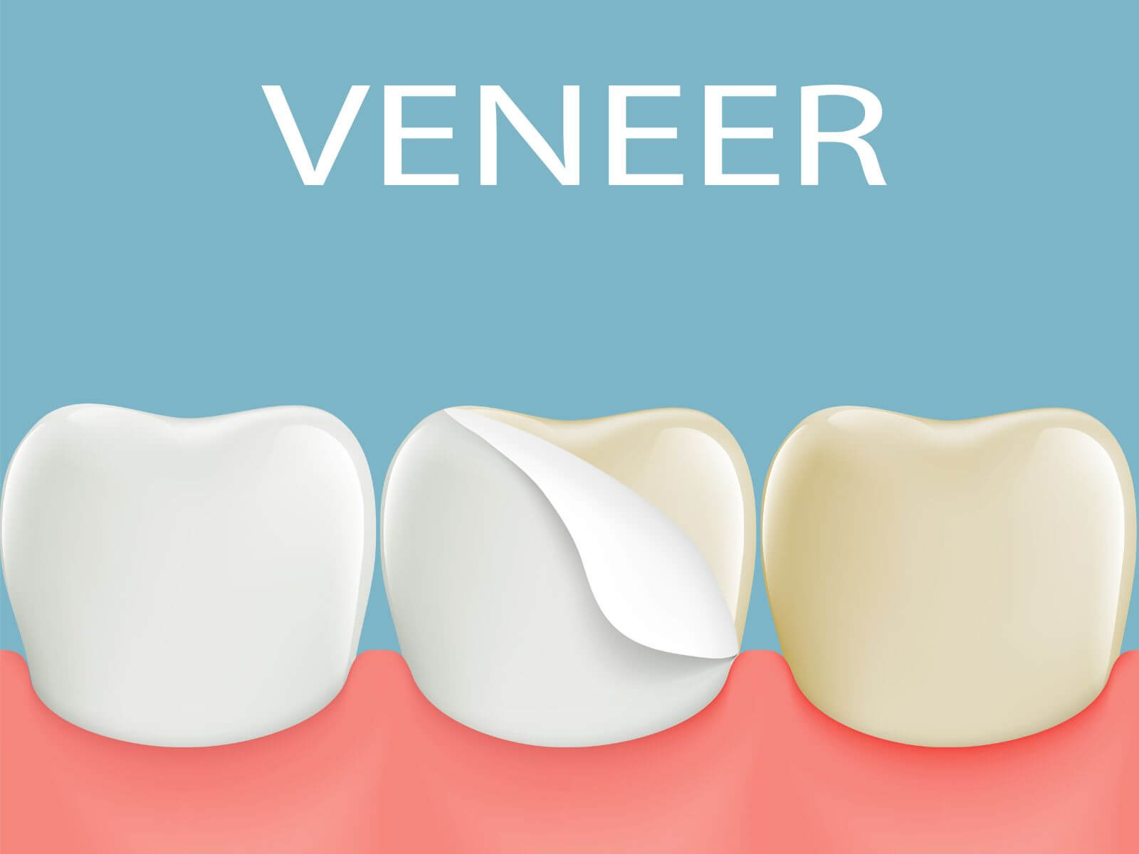 Do You Need To Shave Your Teeth For Veneers?