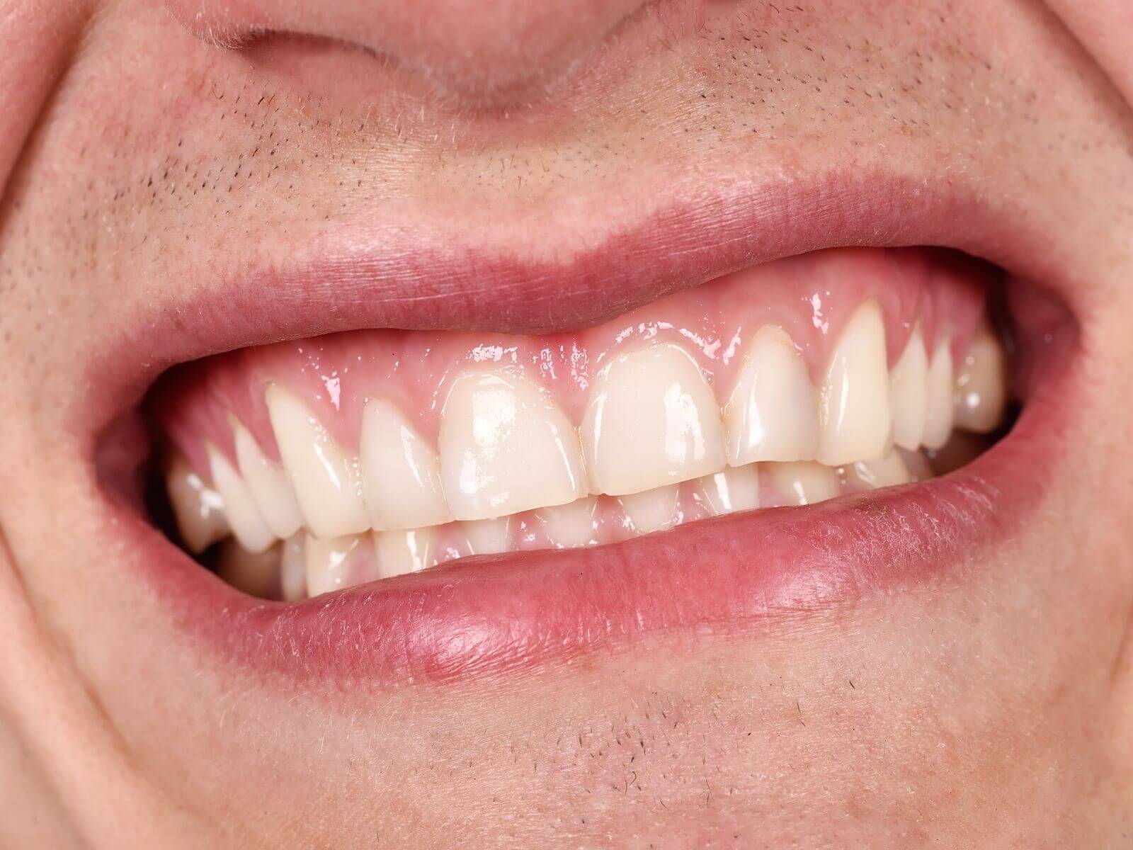 How To Identify Early Signs of Gum Recession