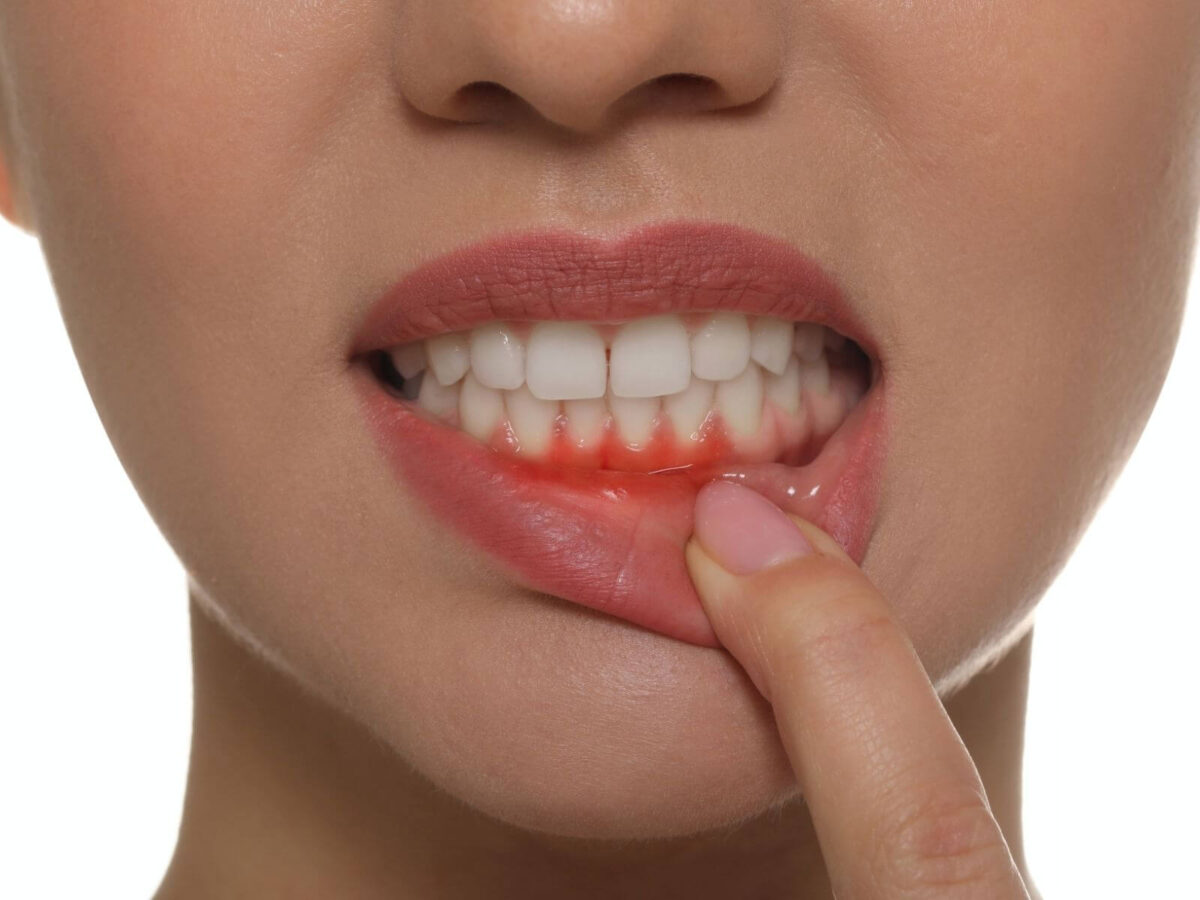 5 Warning Signs of Gum Disease You Shouldn't Ignore