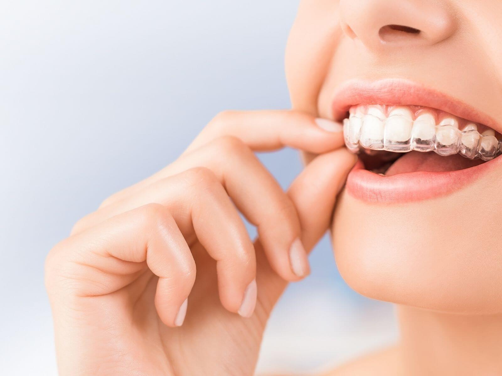 Unlocking The Secret To Effortless Invisalign Maintenance